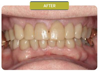 Before and After Results of Patients at Prabhdeep K. Gill DDS in Fresno, CA Before and After Results of Patients at Prabhdeep K. Gill DDS in Fresno, CA
