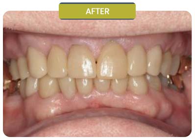 Before and After Results of Patients at Prabhdeep K. Gill DDS in Fresno, CA