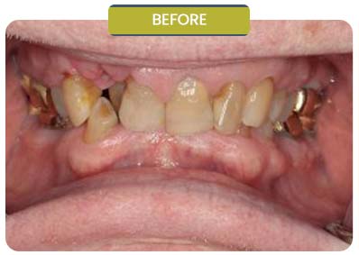 Before and After Results of Patients at Prabhdeep K. Gill DDS in Fresno, CA Before and After Results of Patients at Prabhdeep K. Gill DDS in Fresno, CA