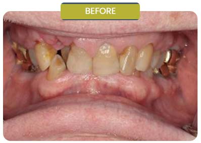 Before and After Results of Patients at Prabhdeep K. Gill DDS in Fresno, CA