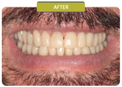 Before and After Results of Patients at Prabhdeep K. Gill DDS in Fresno, CA