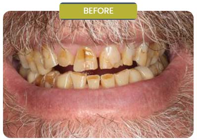 Before and After Results of Patients at Prabhdeep K. Gill DDS in Fresno, CA