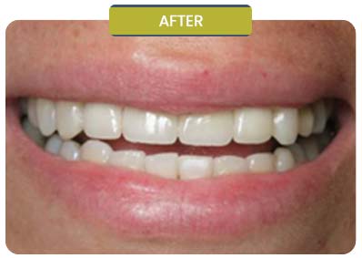 Before and After Results of Patients at Prabhdeep K. Gill DDS in Fresno, CA Before and After Results of Patients at Prabhdeep K. Gill DDS in Fresno, CA