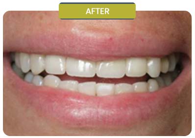 Before and After Results of Patients at Prabhdeep K. Gill DDS in Fresno, CA