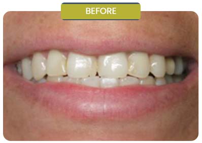 Before and After Results of Patients at Prabhdeep K. Gill DDS in Fresno, CA