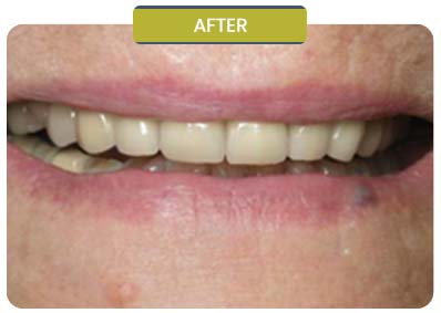 Before and After Results of Patients at Prabhdeep K. Gill DDS in Fresno, CA