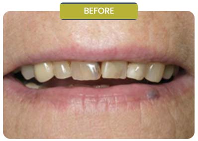 Before and After Results of Patients at Prabhdeep K. Gill DDS in Fresno, CA