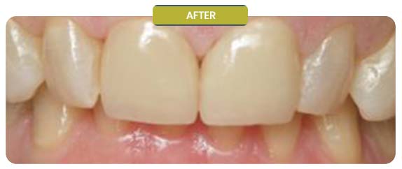 Before and After Results of Patients at Prabhdeep K. Gill DDS in Fresno, CA