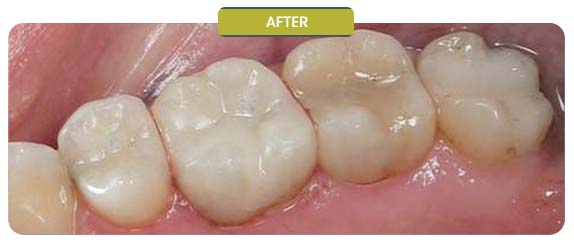 Before and After Results of Patients at Prabhdeep K. Gill DDS in Fresno, CA