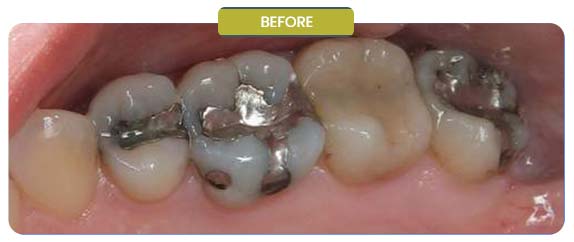 Before and After Results of Patients at Prabhdeep K. Gill DDS in Fresno, CA