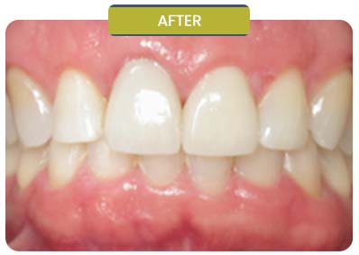 Before and After Results of Patients at Prabhdeep K. Gill DDS in Fresno, CA