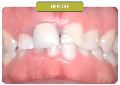 Before and After Results of Patients at Prabhdeep K. Gill DDS in Fresno, CA