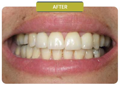 Before and After Results of Patients at Prabhdeep K. Gill DDS in Fresno, CA