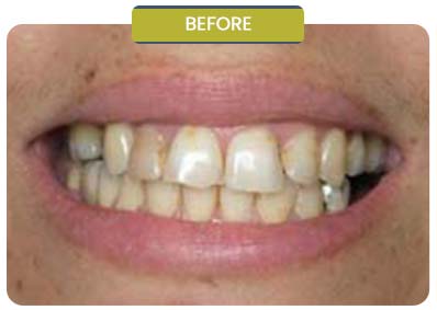 Before and After Results of Patients at Prabhdeep K. Gill DDS in Fresno, CA Before and After Results of Patients at Prabhdeep K. Gill DDS in Fresno, CA