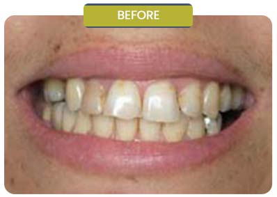 Before and After Results of Patients at Prabhdeep K. Gill DDS in Fresno, CA