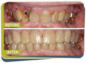 Before and After - Prabhdeep K. Gill DDS in Fresno, CA