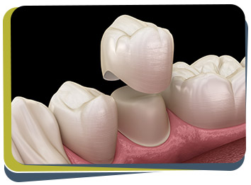 Crowns & Bridges - Prabhdeep K. Gill DDS Near Me in Fresno, CA