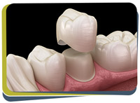 Crowns & Bridges - Prabhdeep K. Gill DDS Near Me in Fresno, CA