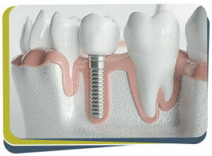 Tooth Replacement Treatment Near Me in Fresno, CA