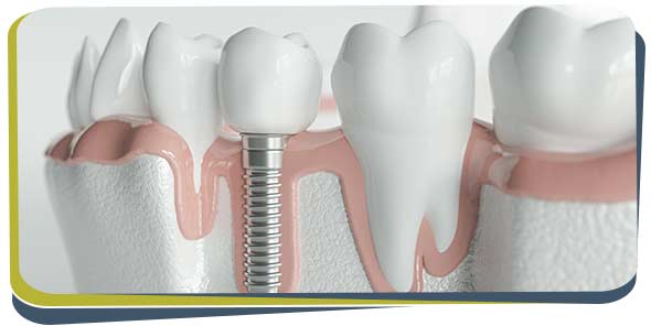 Tooth Replacement Specialist Near Me in Fresno CA Tooth Replacement Specialist Near Me in Fresno CA