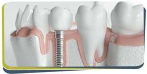 Tooth Replacement Specialist Near Me in Fresno CA Tooth Replacement Specialist Near Me in Fresno CA