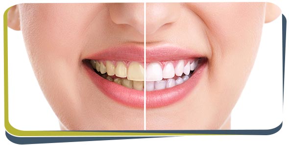 Teeth Whitening Cost Near Me in Fresno CA