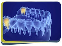 Wisdom Tooth Dentist Near Me in Fresno, CA