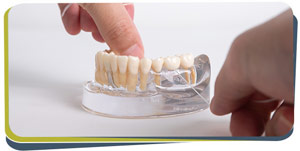 Dental Bridges: A Solution for Missing Teeth Near Me in Fresno, CA