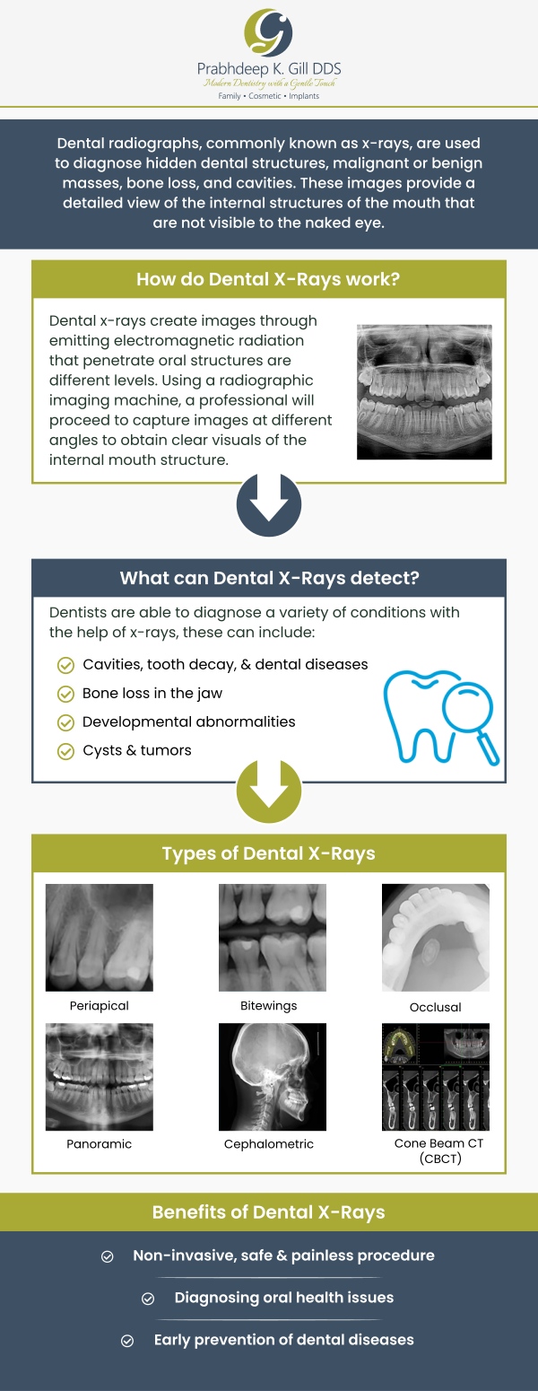 Digital dental X-rays are essential preventative and diagnostic tools that provide significant information that is not noticeable during a routine dental visit. It produces enhanced, more accurate pictures that are less harmful to the body than regular X-rays. Prabhdeep K Gill DDS offers advanced digital X-ray technology to give our patients the most advanced possible care. Digital dental X-rays are quick, accurate, and safe. For more information, contact us or schedule an appointment online today! We are conveniently located at 7215 N First St Suite 107 Fresno CA 93720. Digital dental X-rays are essential preventative and diagnostic tools that provide significant information that is not noticeable during a routine dental visit. It produces enhanced, more accurate pictures that are less harmful to the body than regular X-rays. Prabhdeep K Gill DDS offers advanced digital X-ray technology to give our patients the most advanced possible care. Digital dental X-rays are quick, accurate, and safe. For more information, contact us or schedule an appointment online today! We are conveniently located at 7215 N First St Suite 107 Fresno CA 93720.