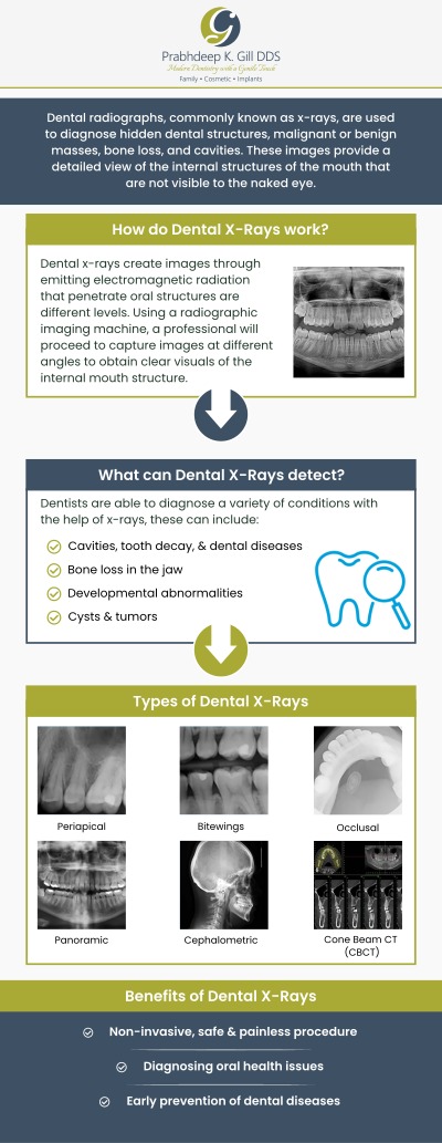 Digital dental X-rays are essential preventative and diagnostic tools that provide significant information that is not noticeable during a routine dental visit. It produces enhanced, more accurate pictures that are less harmful to the body than regular X-rays. Prabhdeep K Gill DDS offers advanced digital X-ray technology to give our patients the most advanced possible care. Digital dental X-rays are quick, accurate, and safe. For more information, contact us or schedule an appointment online today! We are conveniently located at 7215 N First St Suite 107 Fresno CA 93720. Digital dental X-rays are essential preventative and diagnostic tools that provide significant information that is not noticeable during a routine dental visit. It produces enhanced, more accurate pictures that are less harmful to the body than regular X-rays. Prabhdeep K Gill DDS offers advanced digital X-ray technology to give our patients the most advanced possible care. Digital dental X-rays are quick, accurate, and safe. For more information, contact us or schedule an appointment online today! We are conveniently located at 7215 N First St Suite 107 Fresno CA 93720.