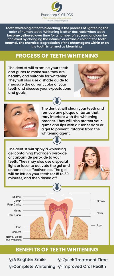 The cost of teeth whitening treatment varies depending on the method and the severity of staining. Dr. Prabhdeep K. Gill offers affordable teeth whitening options in Fresno, CA, with personalized treatments to suit your needs. Achieve a brighter smile with professional care that fits your budget. For more information, contact us or request an appointment online today! We are conveniently located at 7215 N First St Suite 107 Fresno CA 93720. The cost of teeth whitening treatment varies depending on the method and the severity of staining. Dr. Prabhdeep K. Gill offers affordable teeth whitening options in Fresno, CA, with personalized treatments to suit your needs. Achieve a brighter smile with professional care that fits your budget. For more information, contact us or request an appointment online today! We are conveniently located at 7215 N First St Suite 107 Fresno CA 93720.